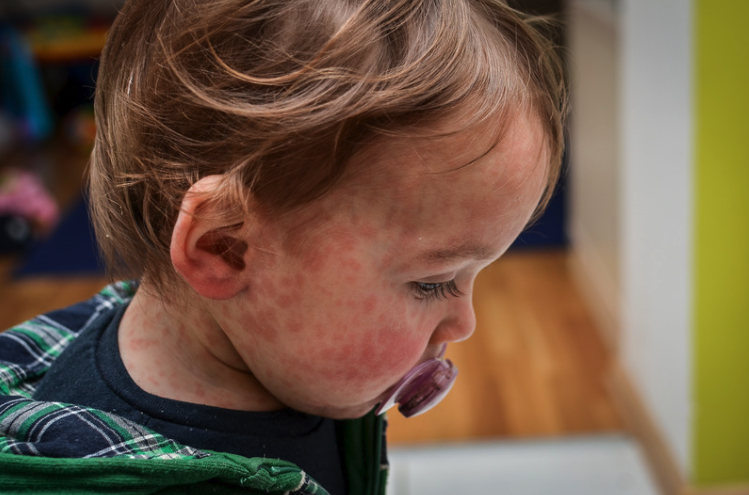 Measles FAQ: What Every Parent Needs to Know